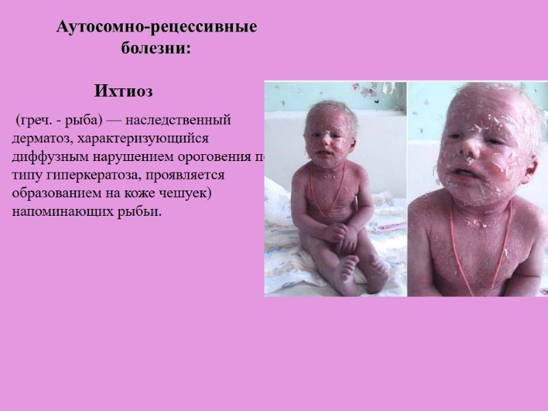 Ихтиоз  (греч. - рыба) — наследственный дерматоз, характеризующийся диффузным нарушением ороговения по типу